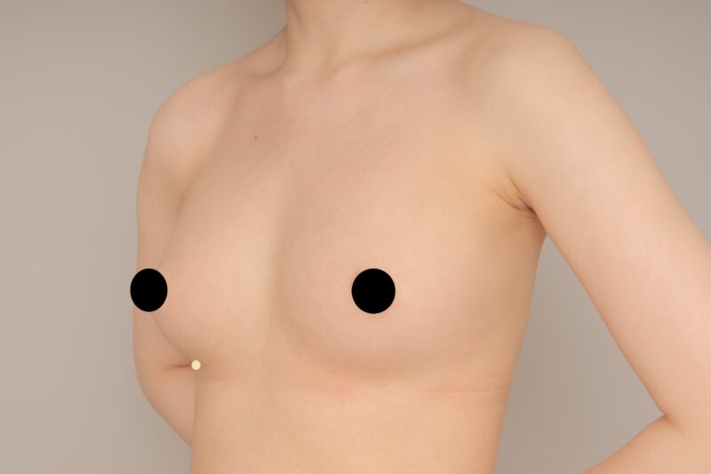 ママの2回目コンデンスリッチ豊胸♪ モニター様の3か月経過をご紹介♪ 27歳 167cm 57kg