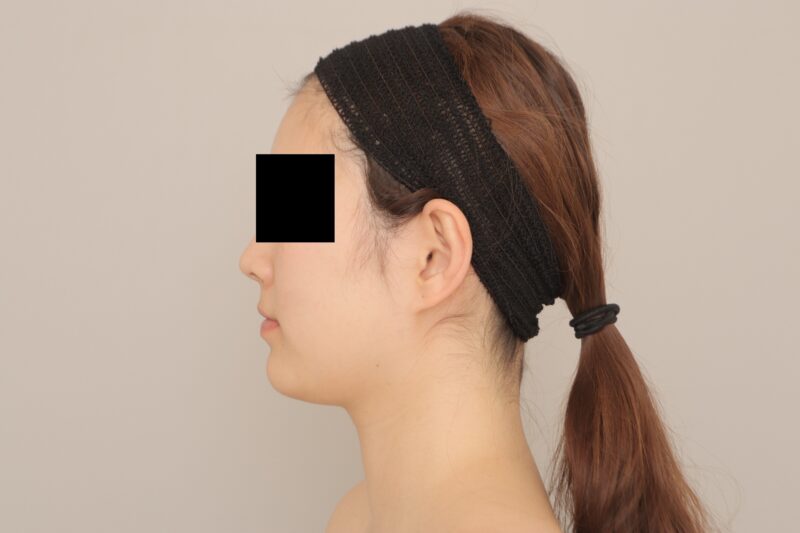 ベイザー脂肪吸引（3か月経過：25）の術前写真
