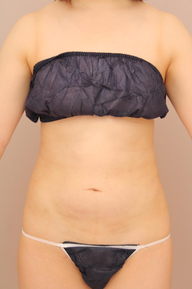 段差のない綺麗なお腹としっかりとしたくびれを叶えます！