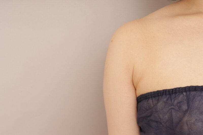 二の腕と脇肉の脂肪吸引、6か月経過です