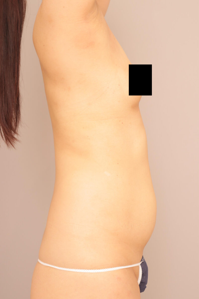 ベイザー脂肪吸引（1ヵ月経過：50）の術前写真