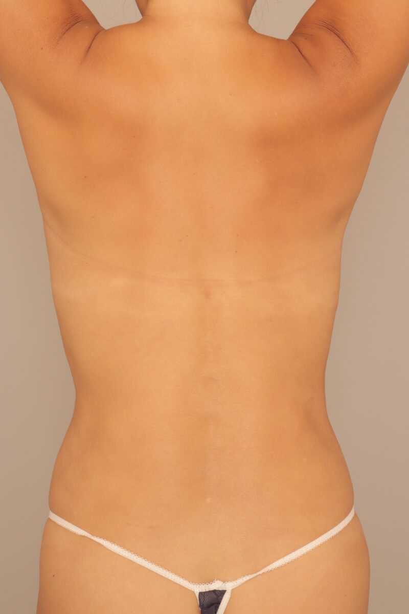 50代モニター様♡背中の脂肪吸引半年後