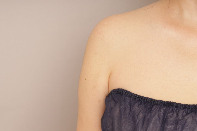 50代の方の二の腕の脂肪吸引です