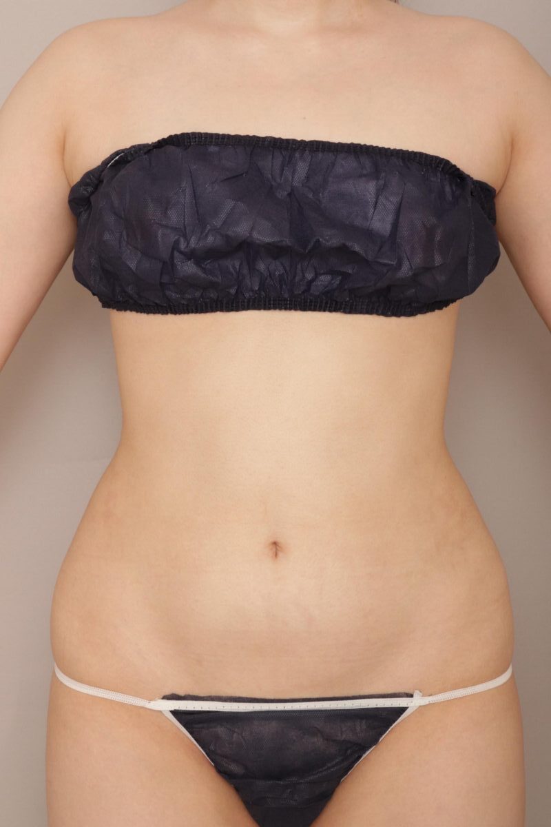 お腹と腰の脂肪吸引で、ワンランク上のスタイルを。