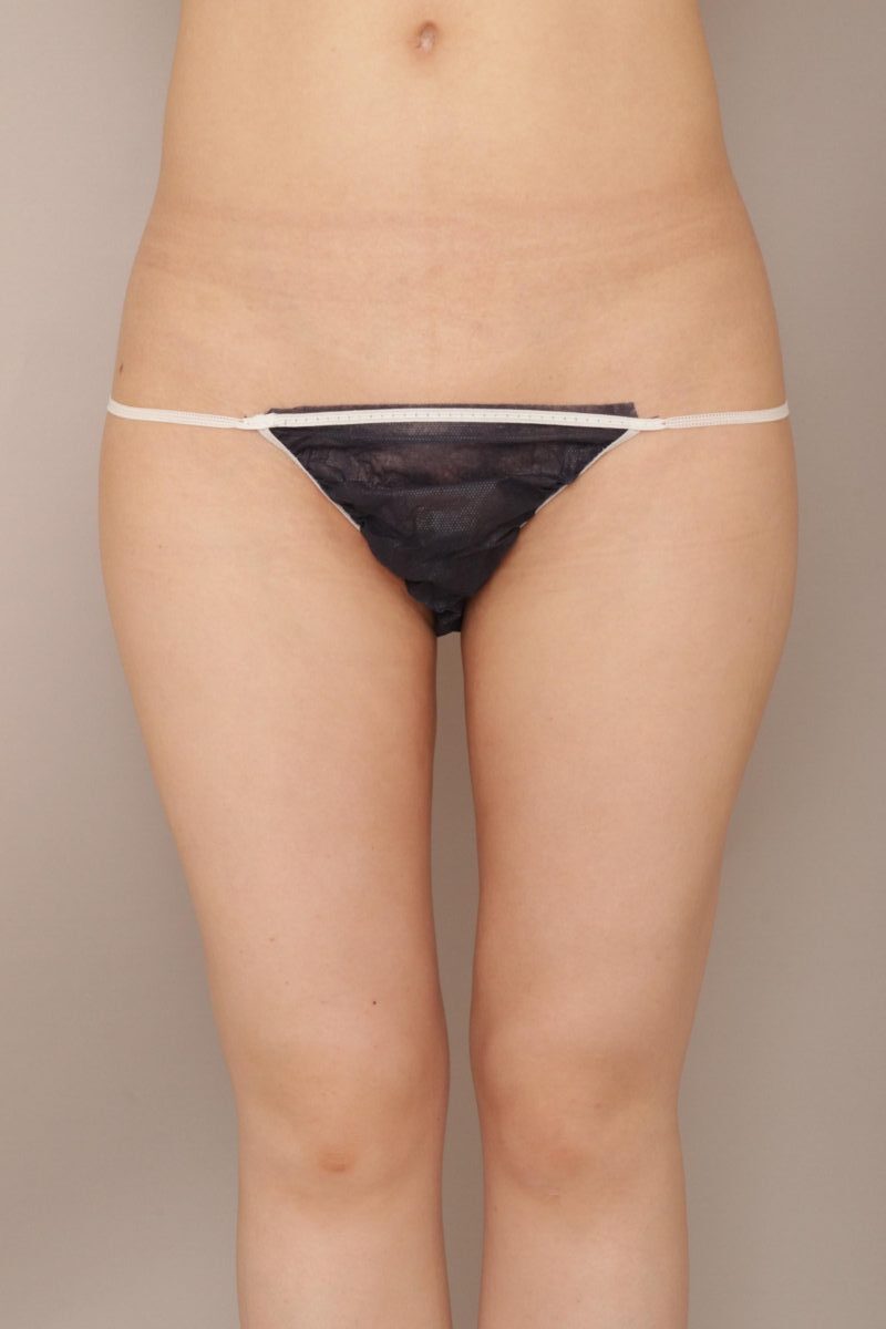 ふとももの脂肪吸引、おすすめです。