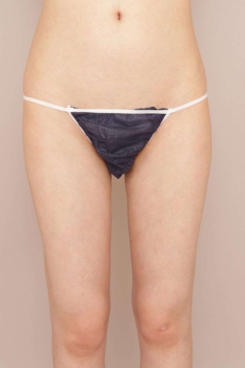 細い方でも、ふとももの脂肪吸引で変わります。