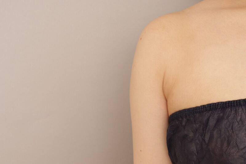 二の腕の脂肪吸引、3か月経過です。