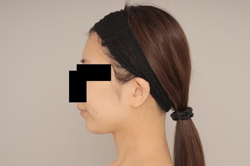 ベイザー脂肪吸引（６か月経過：25）の術前写真