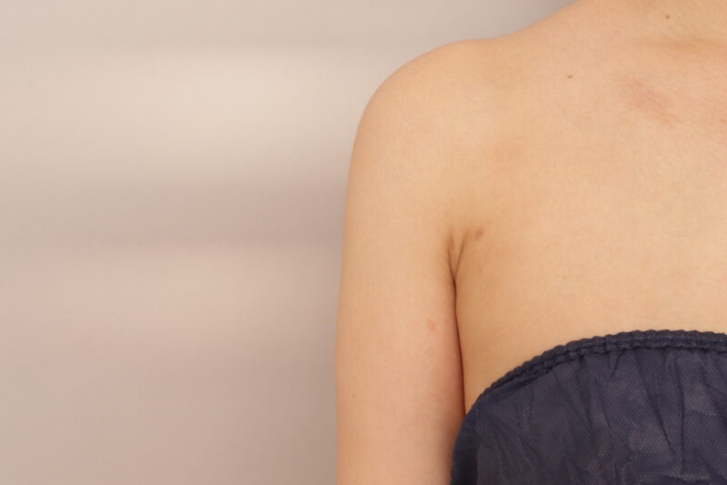 二の腕の脂肪吸引の三ヶ月経過です