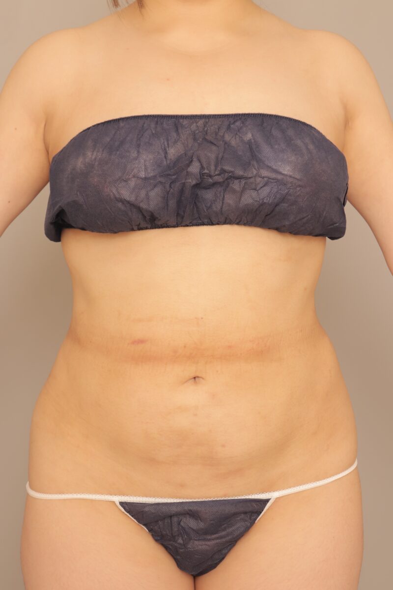 みんなで目指そう峰不二子♡35歳お腹全体胸下腰の脂肪吸引モニター様半年後