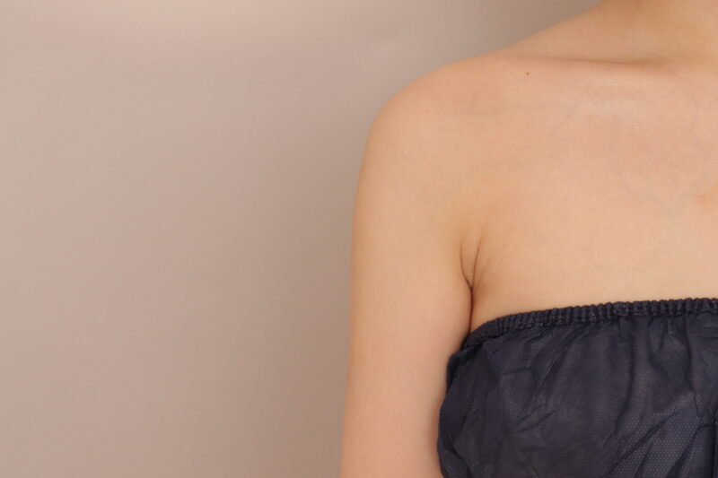 二の腕、脇肉の脂肪吸引 3か月経過のご紹介