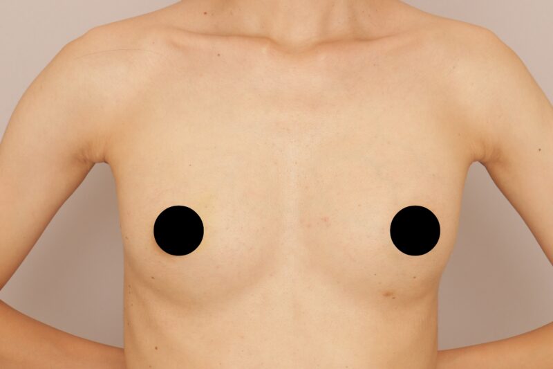 脂肪豊胸、乳頭縮小の一か月経過のご紹介です