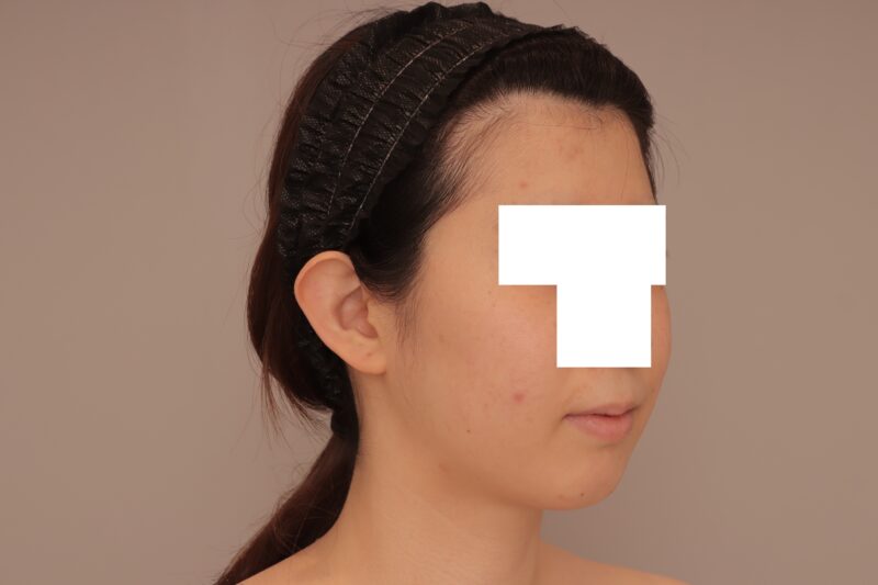 ベイザー脂肪吸引（3ヶ月経過：26）の術前写真