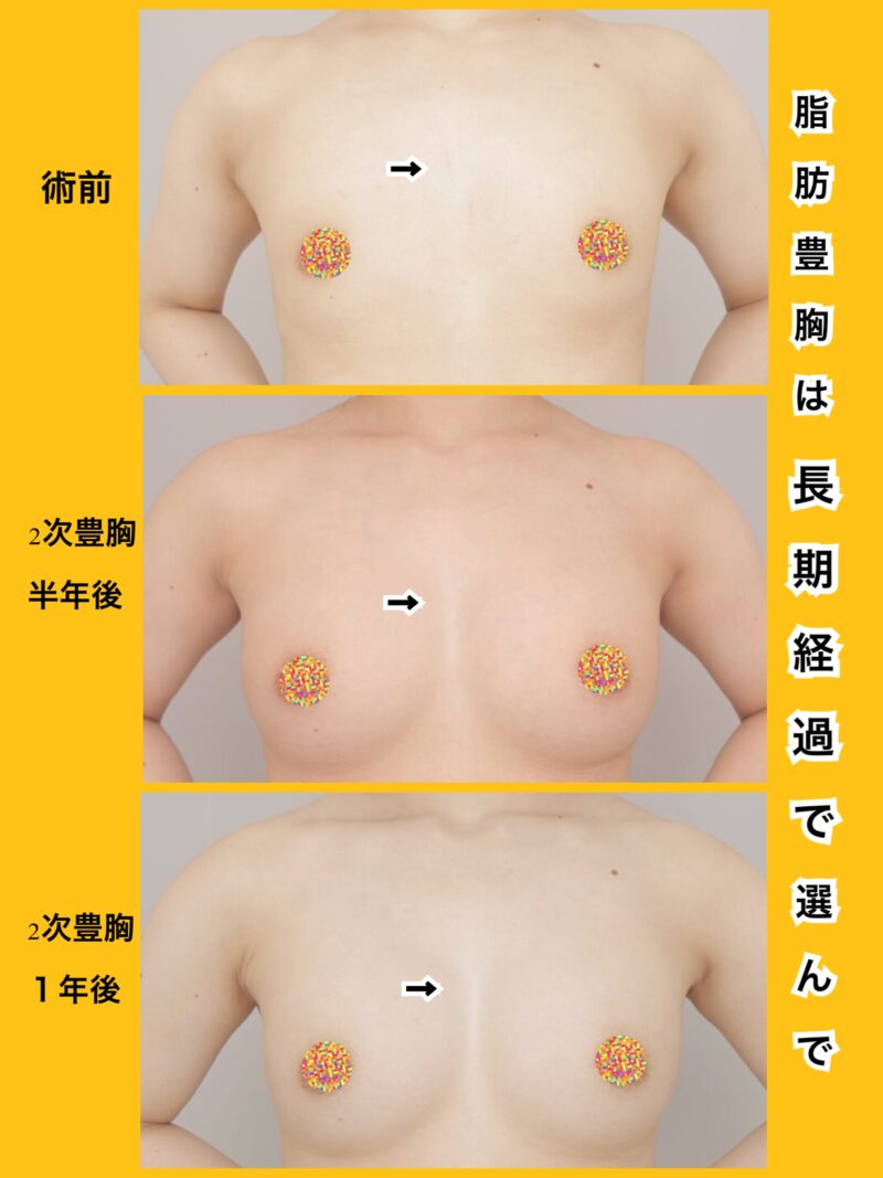 〝長期経過〟で選んで下さい。5カップup!!AA→Eカップ。脂肪豊胸の効果はずっと続きます。～22歳148cm45kg脂肪豊胸（CRFバスト）二次豊胸後時系列半年1年～