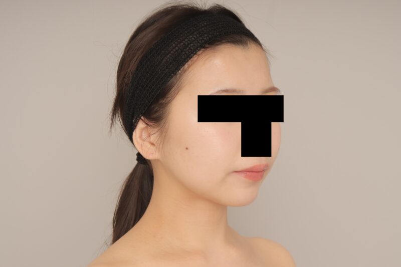 お顔の脂肪吸引は大変人気です