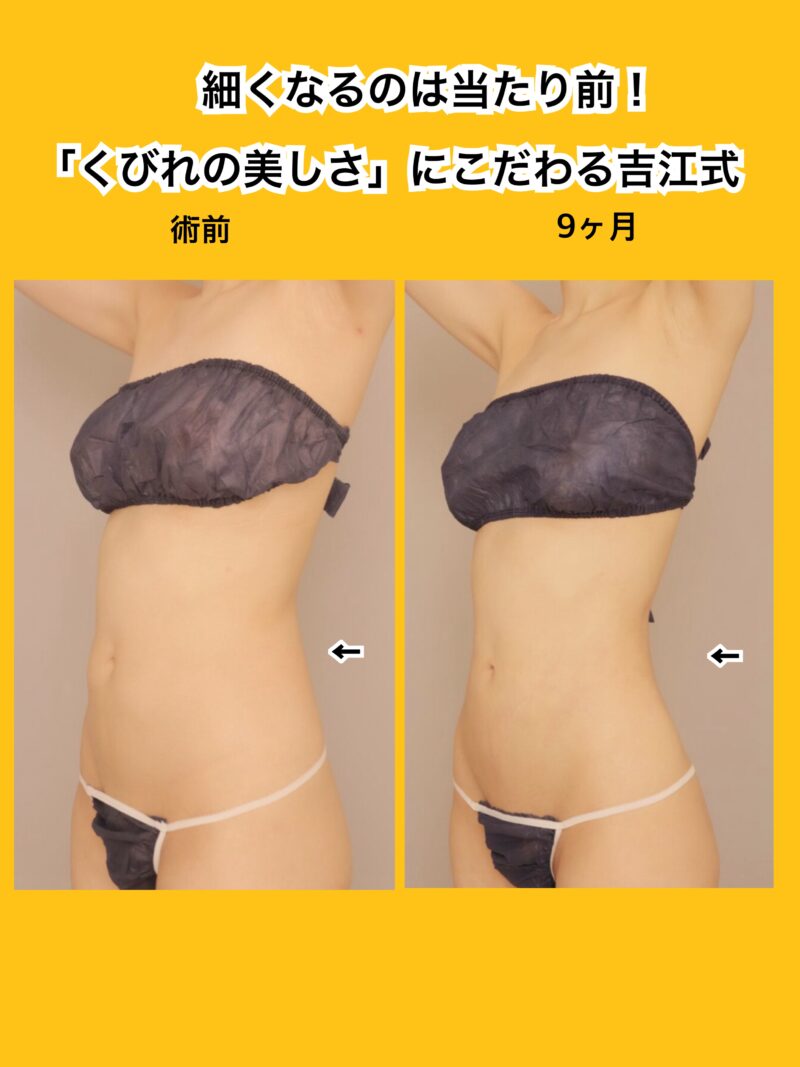長期経過をお見せします！吉江式「綺麗なくびれ」の変化です！～26歳160cm50kg腹部全体胸下腰1800cc吸引後9ヶ月～