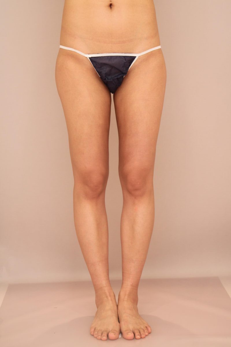 太もも＋臀部の脂肪吸引で美脚に！