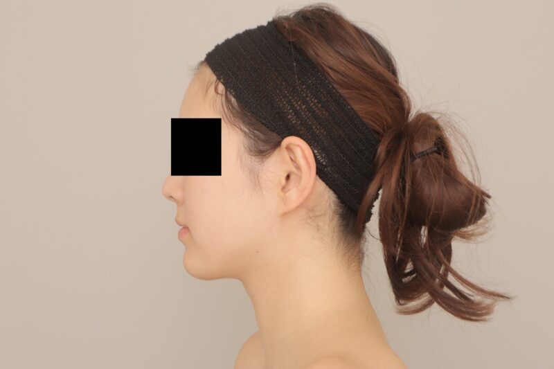 ベイザー脂肪吸引（3か月経過：25）の術後写真