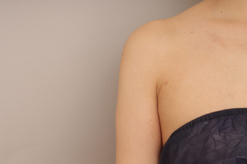 二の腕の脂肪吸引、おすすめです。