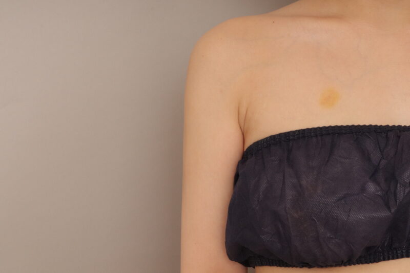 二の腕と脇肉の脂肪吸引、おすすめです