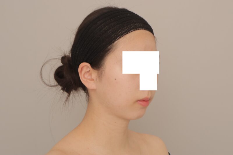 ベイザー脂肪吸引（1ヶ月経過：19）の術後写真