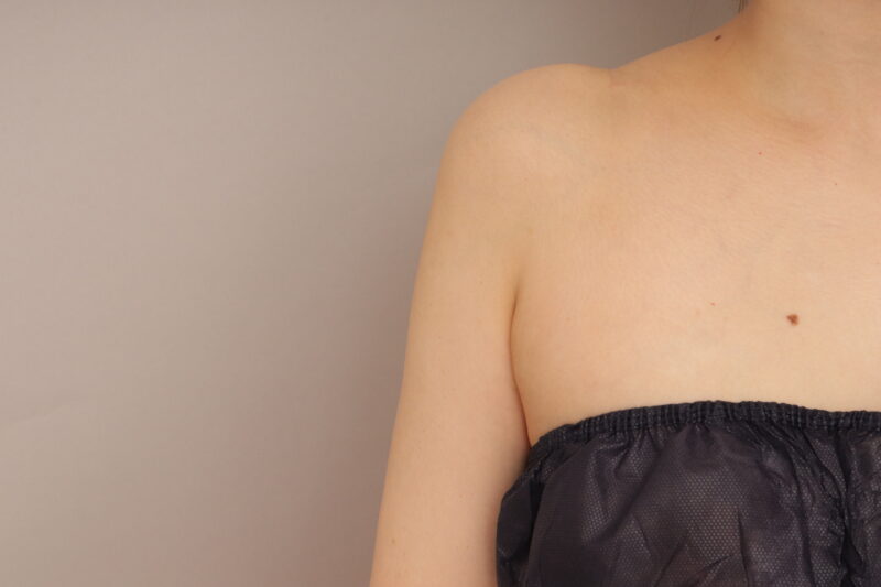 二の腕の脂肪吸引は、おすすめです