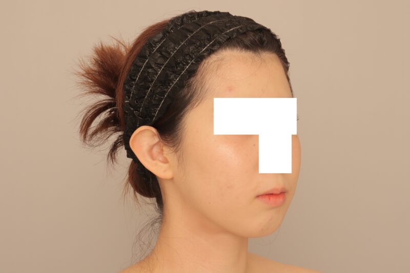 ベイザー脂肪吸引（3ヶ月経過：26）の術後写真