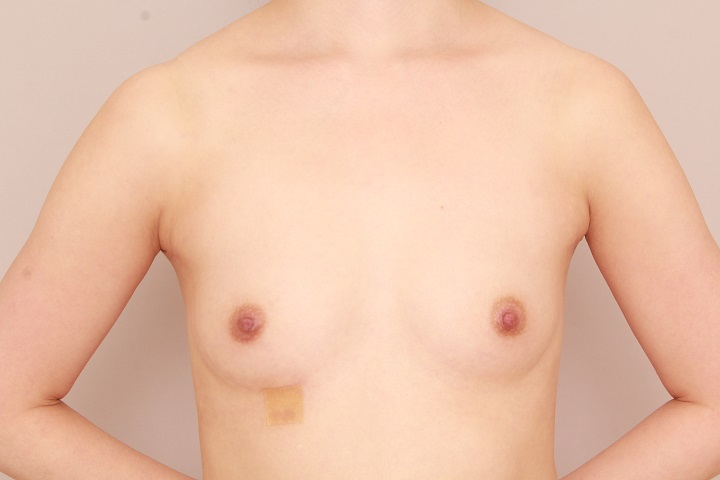 コンデンスリッチ豊胸を２回するとここまでになります。