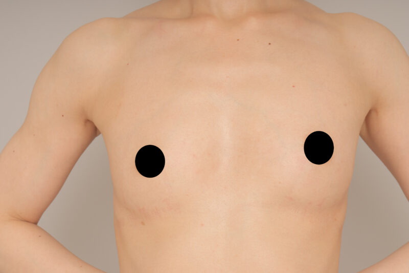 ベイザー脂肪吸引(半年後経過:32)の術前写真