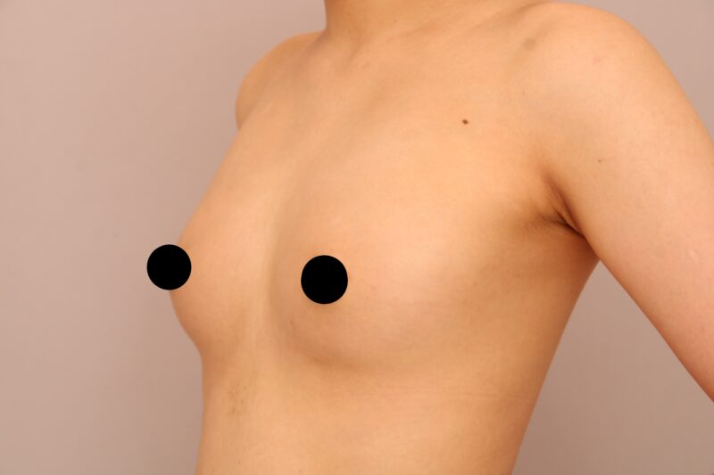 脂肪豊胸でデコルテのそげ感を改善し自然な谷間をデザインできます！