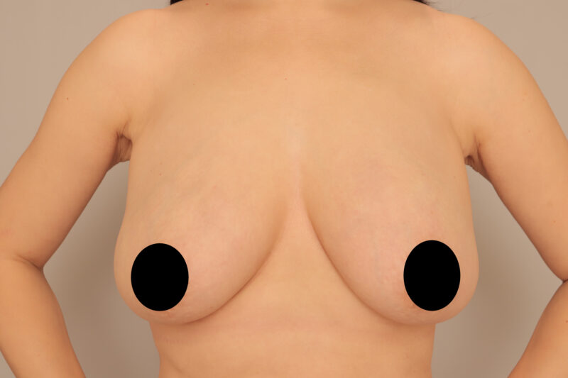 しぼんだ感と垂れが気になるけど乳房吊り上げ術はしたくない！45歳コンデンスリッチ豊胸モニター様半年後