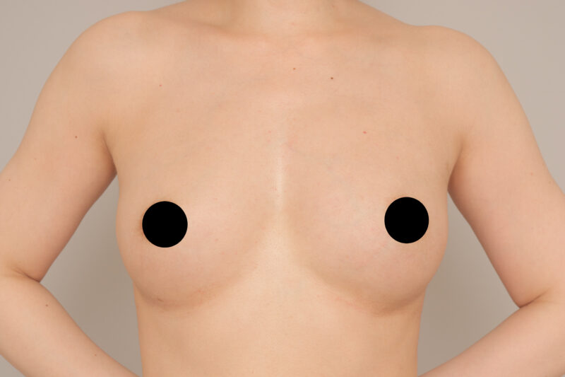 ベイザー脂肪吸引(半年後経過:32)の術後写真