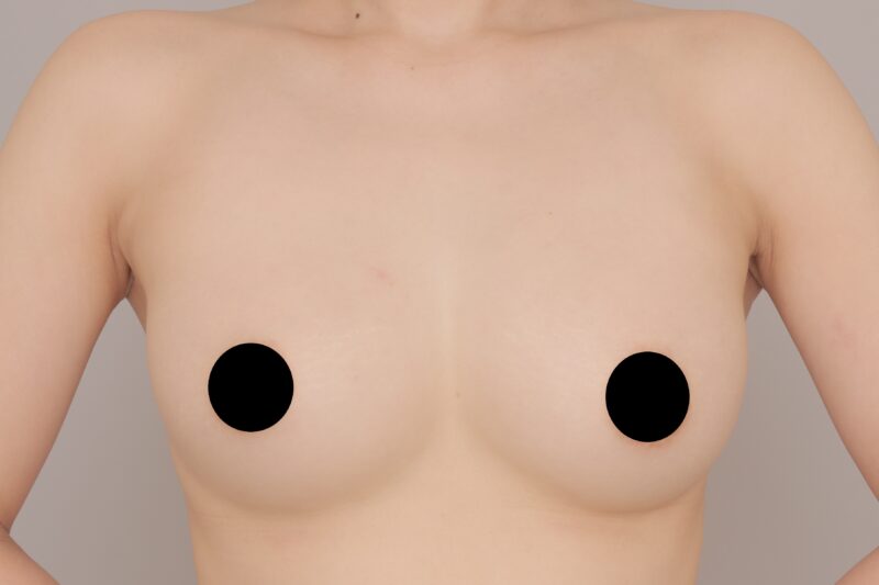 ベイザー脂肪吸引(1ヶ月経過:29)の術後写真