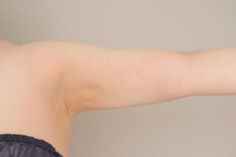 二の腕全周吸引で細く！　モニター様の6か月経過をご紹介♪　36歳 159cm 70kg