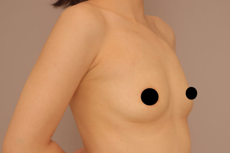 ベイザー脂肪吸引（半年後経過：38）の術前写真