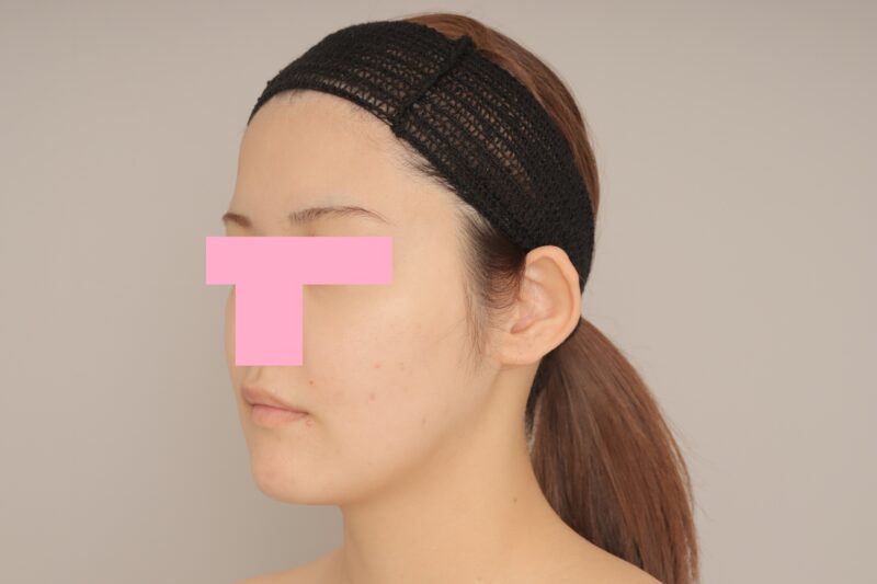 ベイザー脂肪吸引（3か月経過：21）の術後写真