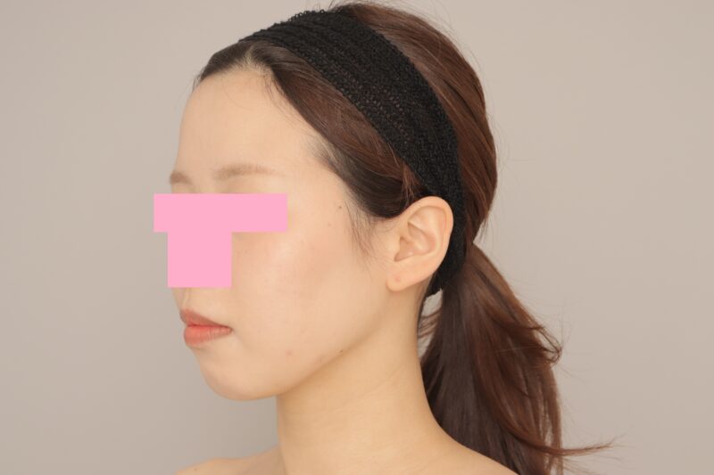 頬顎下脂肪吸引で更に小顔に♪ モニター様の1か月経過をご紹介♪ 26歳 153cm 45kg