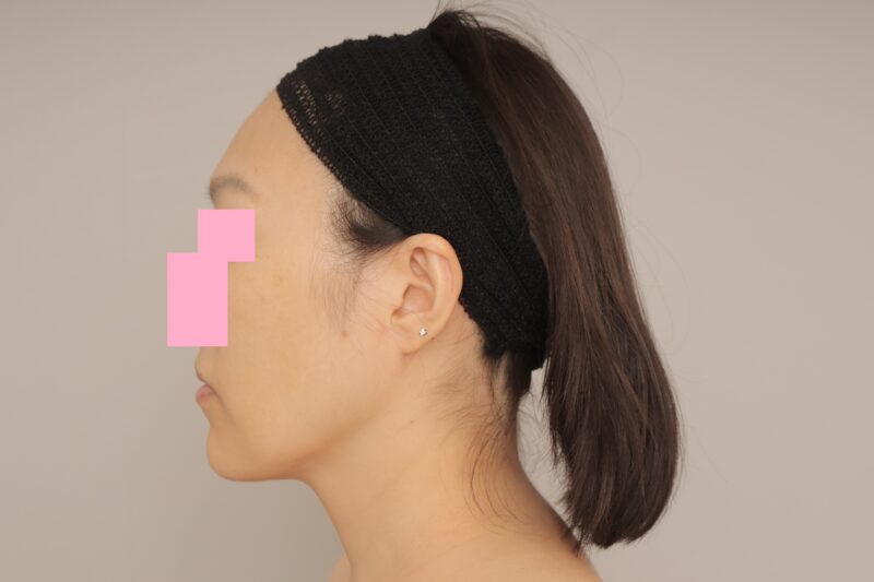 頬顎下脂肪吸引でフェイスラインを美しく♪ モニター様の6か月経過をご紹介♪ 48歳 152cm 50kg