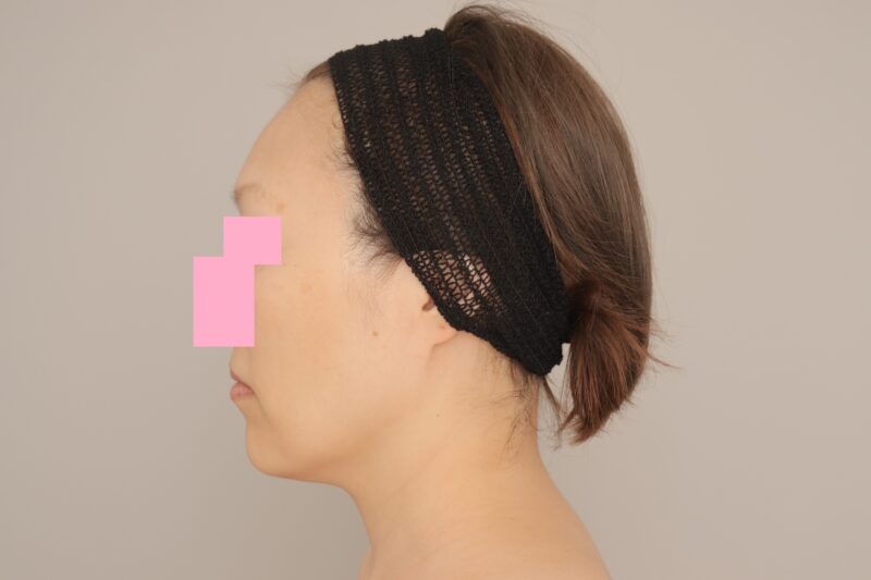 ベイザー脂肪吸引（6か月経過：48）の術前写真