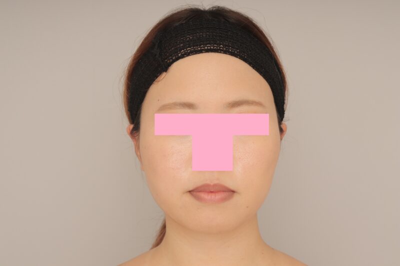 ベイザー脂肪吸引（6か月経過：30）の術後写真