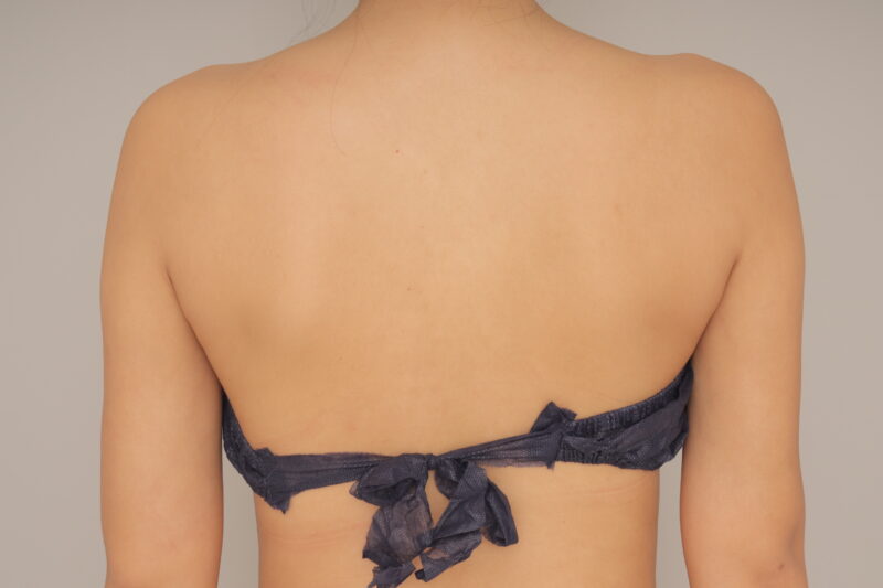 二の腕脂肪吸引で張り出しを失くす♪ モニター様の3 か月経過をご紹介♪ 28歳 165cm 56kg