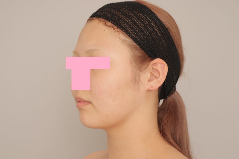 成人式の写真がもれた！！　モニター様の6か月経過をご紹介♪　20歳 163cm 65kg