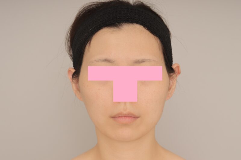 頬顎下脂肪吸引で美しく♪ モニター様の3か月経過をご紹介♪ 31歳 159cm 53kg