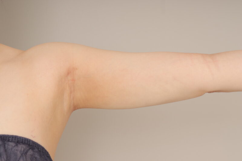 ベイザー脂肪吸引(1ヵ月経過:27)の術後写真