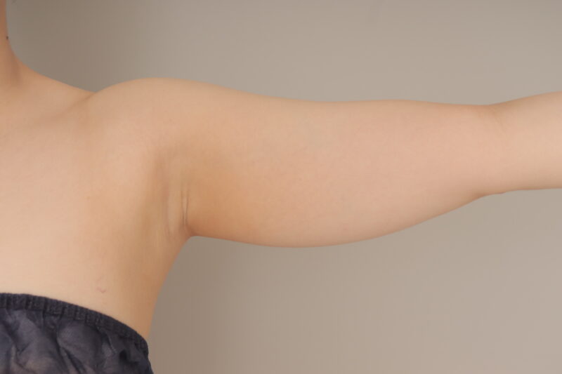 ベイザー脂肪吸引(1ヵ月経過:27)の術前写真