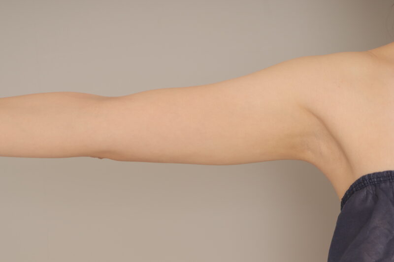 ベイザー脂肪吸引（1ヵ月経過：27）の術後写真