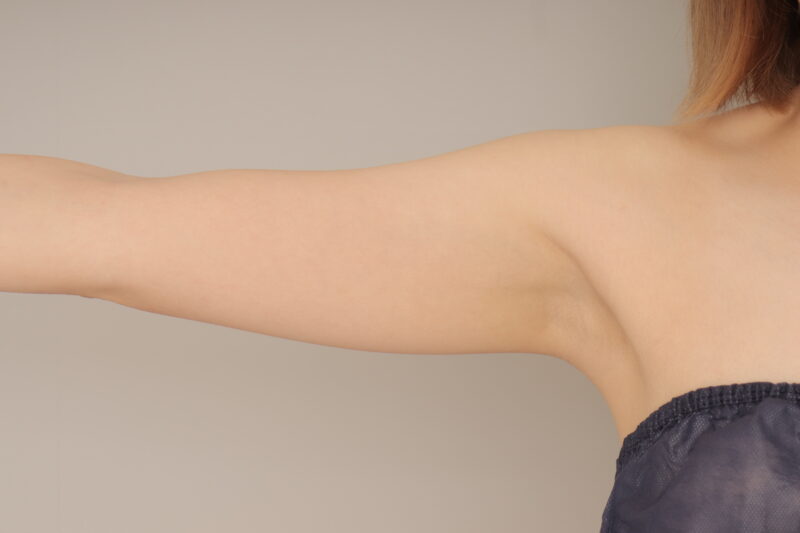 ベイザー脂肪吸引（1ヵ月経過：27）の術前写真