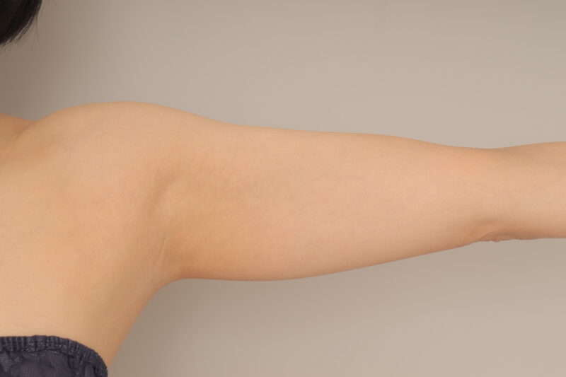 ベイザー脂肪吸引（3か月経過：36）の術前写真