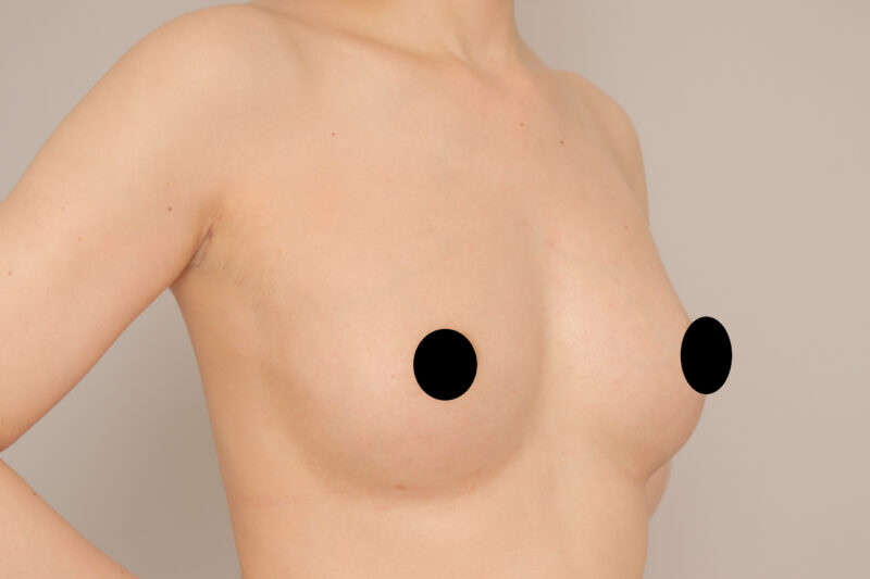 コンデンスリッチ豊胸で別人級のふっくら美バスト♡