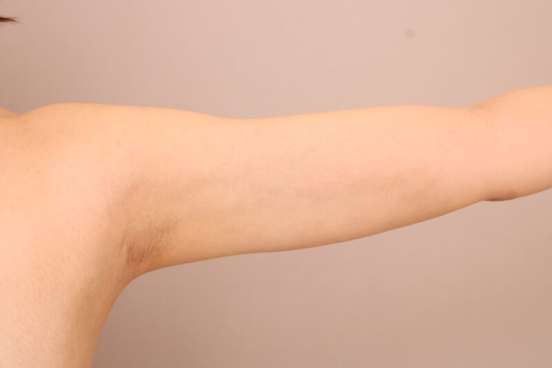 二の腕＋肩は肘の伸側の1カ所のお傷で脂肪吸引ができます！